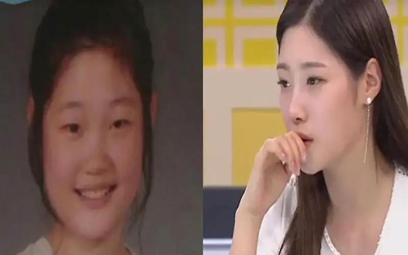 Jung Chae-Yeon: cosmetic surgery